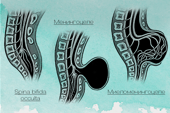 Все, что нужно знать о spina bifida